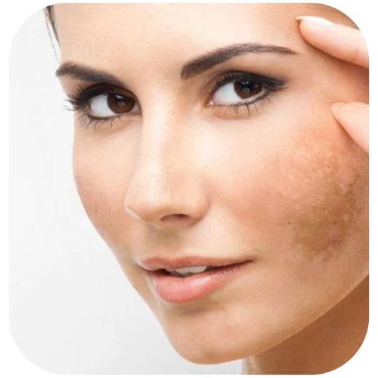 manchas facial tratamientos faciales estetica nuevos aires